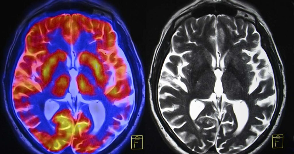Study Pinpoints Three Major Contributors to Dementia Risk - Featured image
