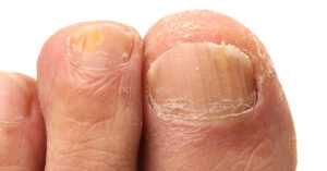 Thick toenails