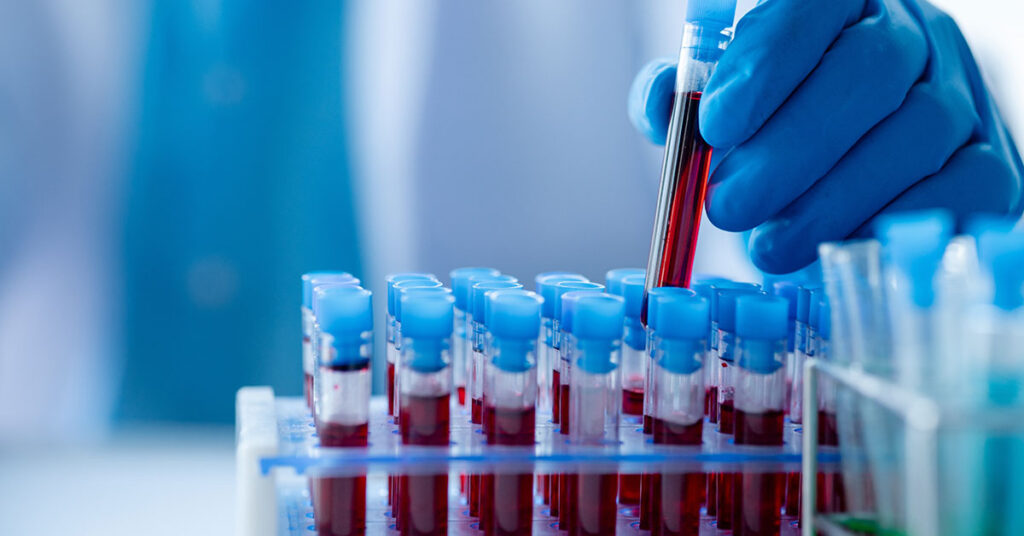 Study Finds People with Certain Blood Type Are Prone to Early Stroke - Featured image