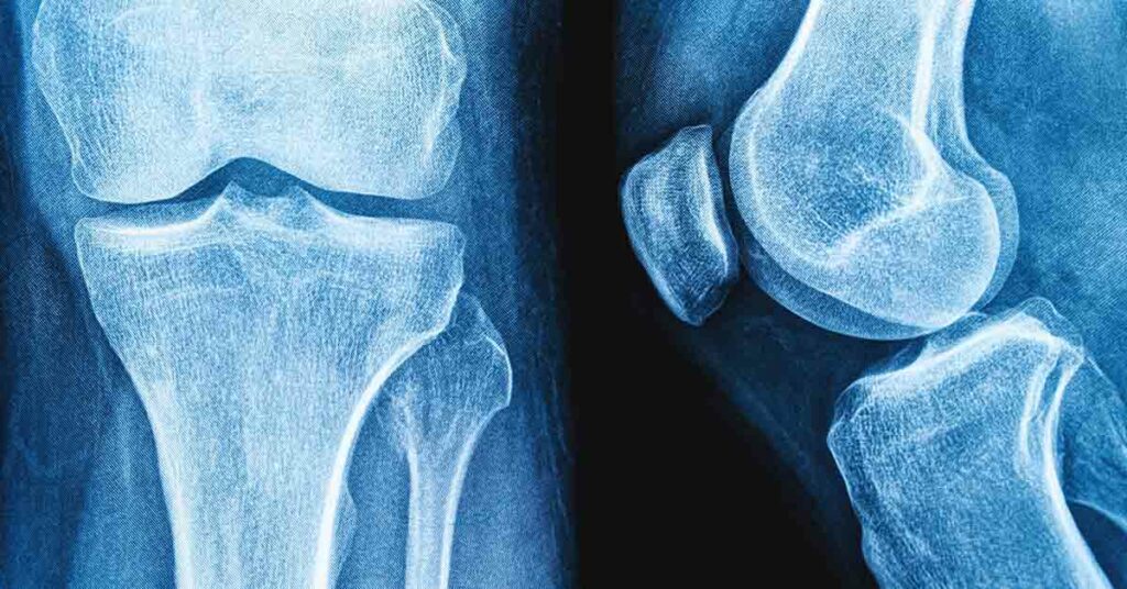 Do Soft Drinks Have a Negative Impact on Bone Health and Strength? - Featured image