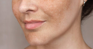 How To Reduce Age Spots: Causes, Treatment, and Prevention age spots on woman's cheeks