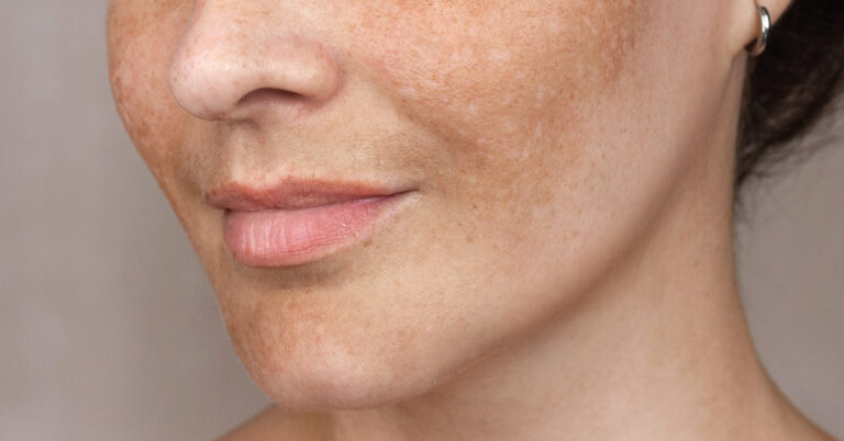 How To Reduce Age Spots: Causes, Treatment, and Prevention - Featured image