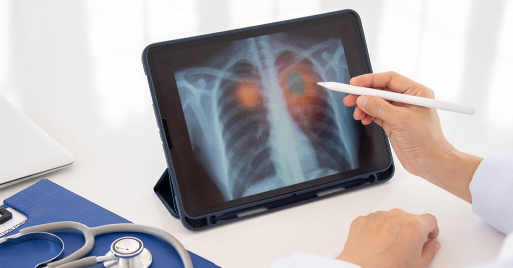 New Study Links High Sugar Diet to Lung Cancer, Shedding Light on Diet’s Role in Health - Featured image