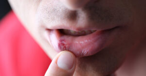 Could a Common STI Be Linked to Dementia? Experts Raise Concerns. herpes sore on someone lip