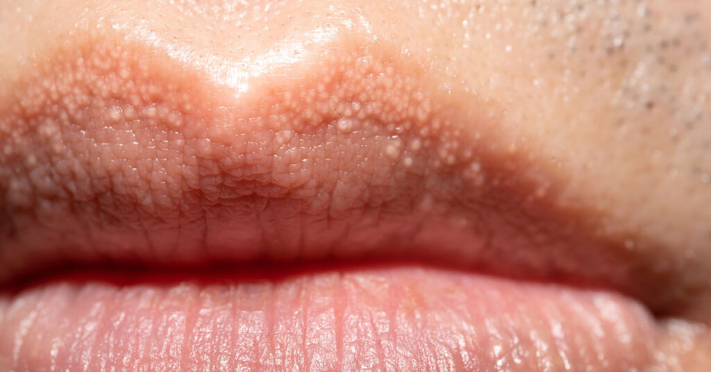 What Are Those White Bumps That Can Appear On Your Private Parts and What Causes Them? - Featured image