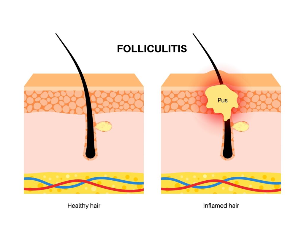 Folliculitis medical poster. Inflamed follicles with bacteria or infection. Pimple with pus in hair follicle. Itchy, sore and painful areas. Skin layers diagram, epidermis, dermis vector illustration