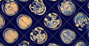 Medical miracle: Man With 90% of His Brain Damaged Defies Expectations ...