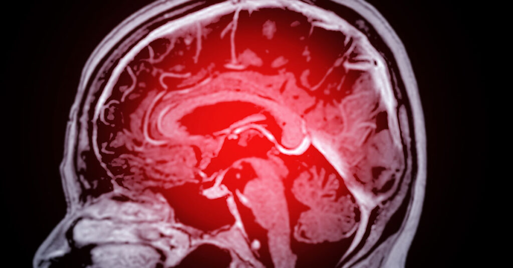 4 Dementia Symptoms You Might Notice Before Memory Loss Sets In - Featured image