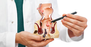 doctor holding model of cross section of human large bowel with focus on the anus and rectum