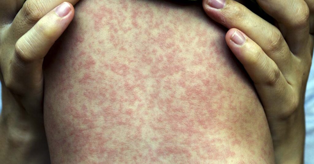 This is What Measles Does to Your Body - Featured image