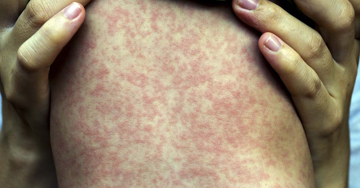 measles rash
