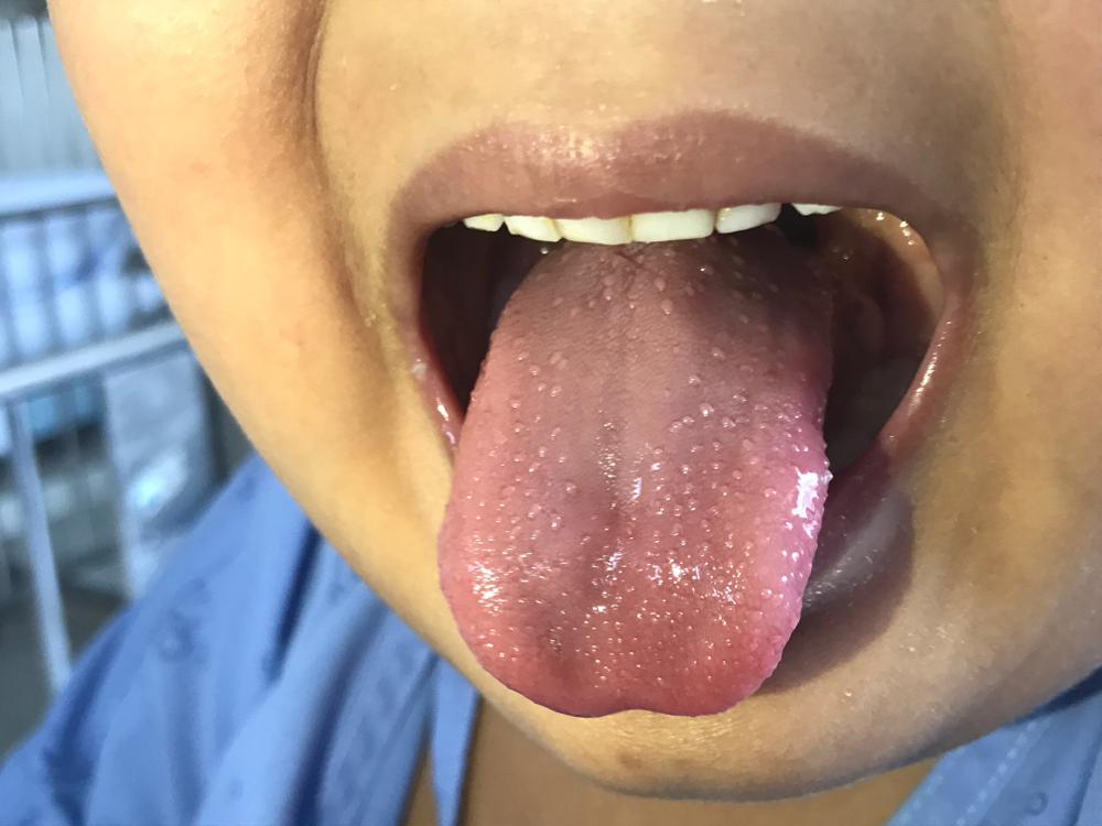 Strawberry tongue in case scarlet fever. (Strawberry tongue is the name given to a swollen, bumpy tongue. Most often, the enlarged tongue is very red, like a strawberry or raspberry.)