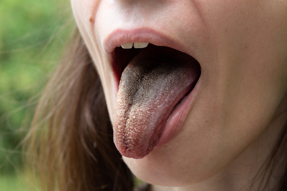 Woman black hairy tongue out of mouth