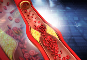 Clogged,Arteries,,Cholesterol,Plaque,In,Artery.,3d,Illustration