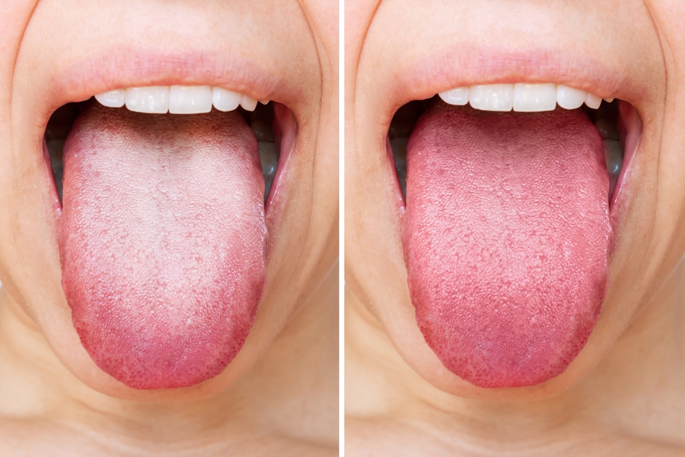Female tongue with a white plaque. Comparison of a diseased tongue with a white plaque and a healthy clean tongue before and after treatment. The result of cleaning the tongue