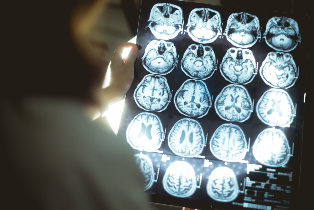 brain scan for Dementia