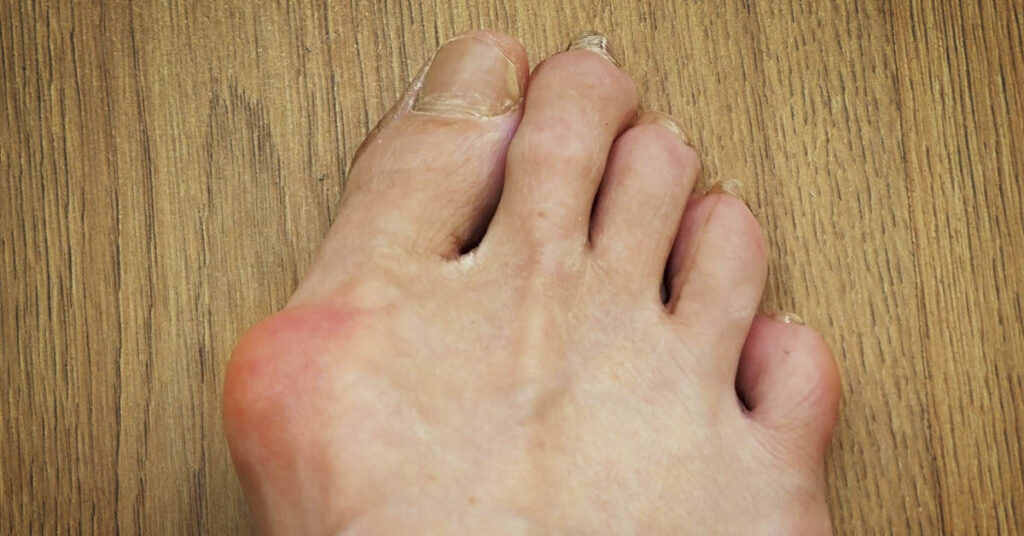Why Do We Have Bunions? You Can Blame Evolution. - Featured image