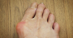 Why Do We Have Bunions? You Can Blame Evolution. large bunion on left side of person's foot just under big toe