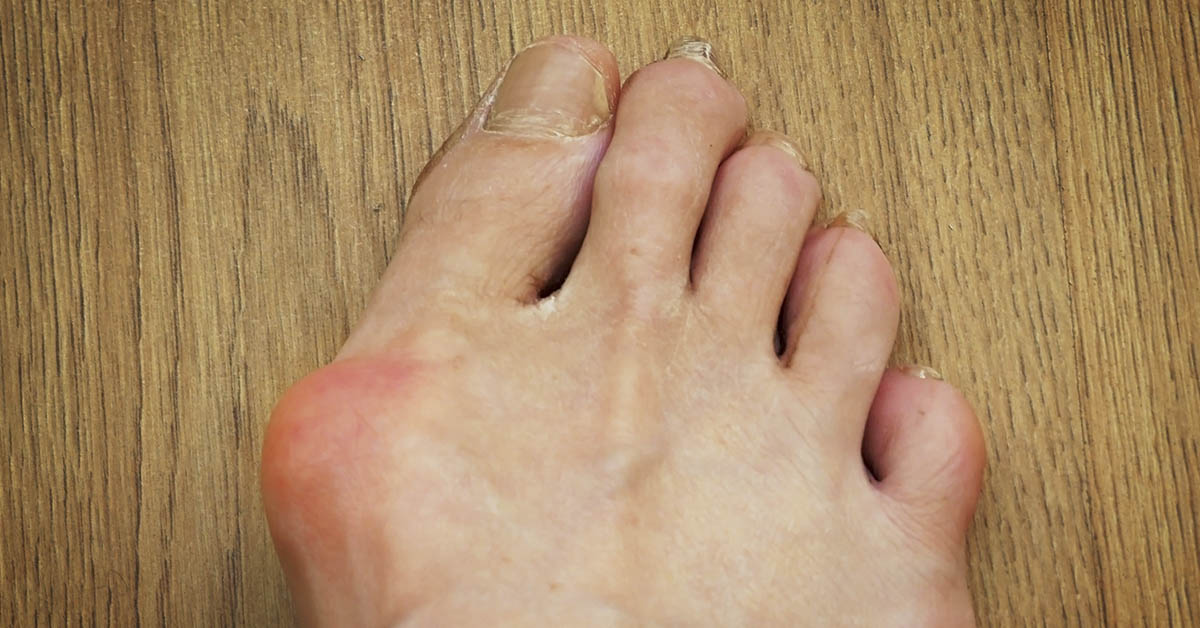 large bunion on left side of person's foot just under big toe