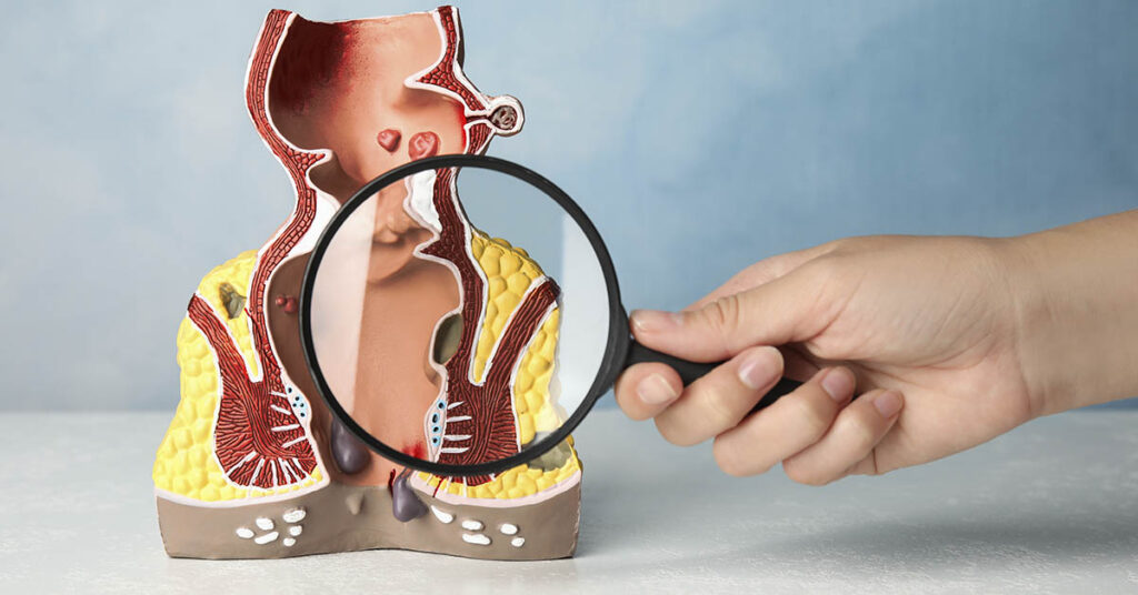 Anal Cancer On the Rise, Study Highlights Most Vulnerable Population - Featured image