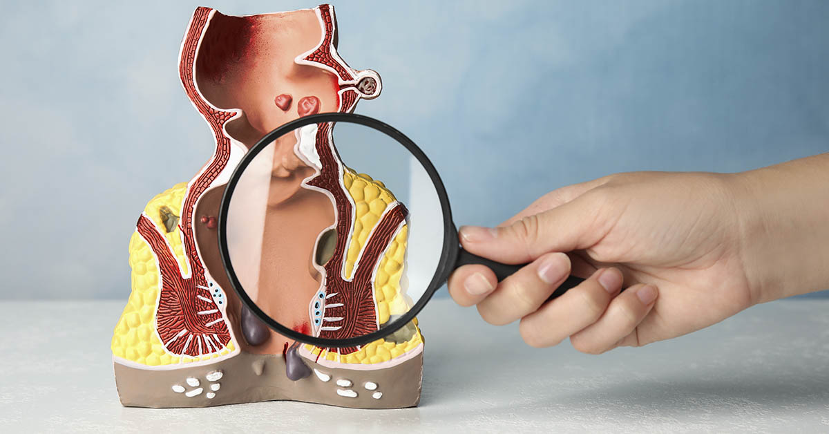 magnifying glass placed over 3D model of lower colon and anus. Anal health concept, anal cancer