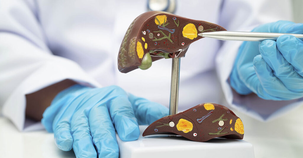 Drug That Elevates NAD+ Offers New Hope for Fatty Liver Disease - Featured image