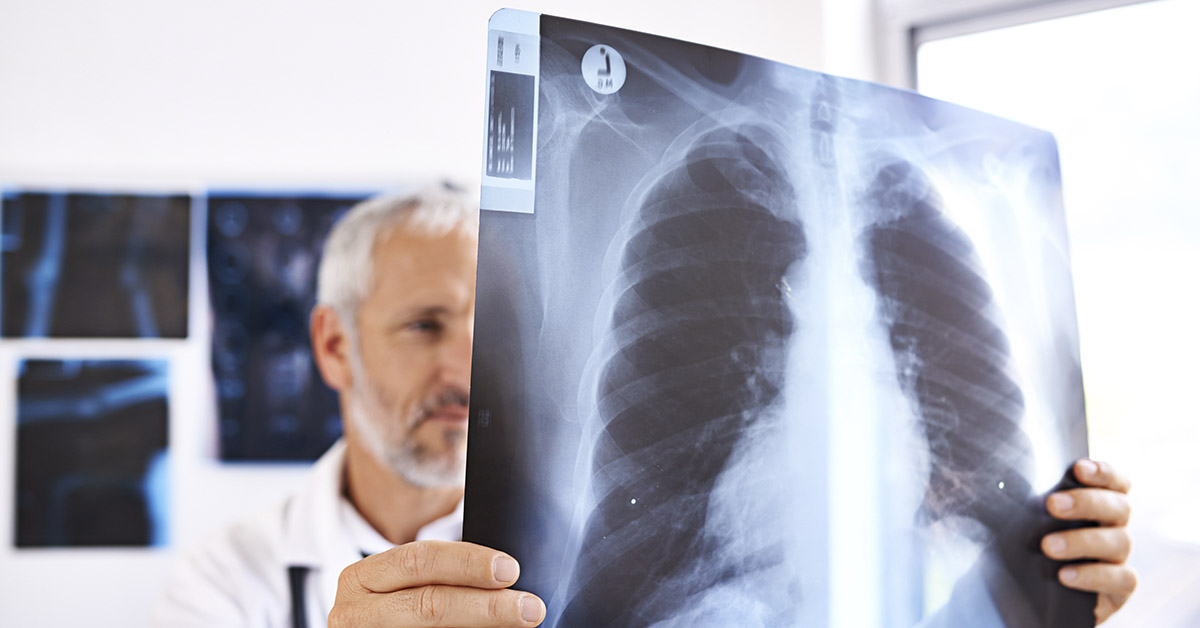 doctor holding up a chest X-ray revealing lungs