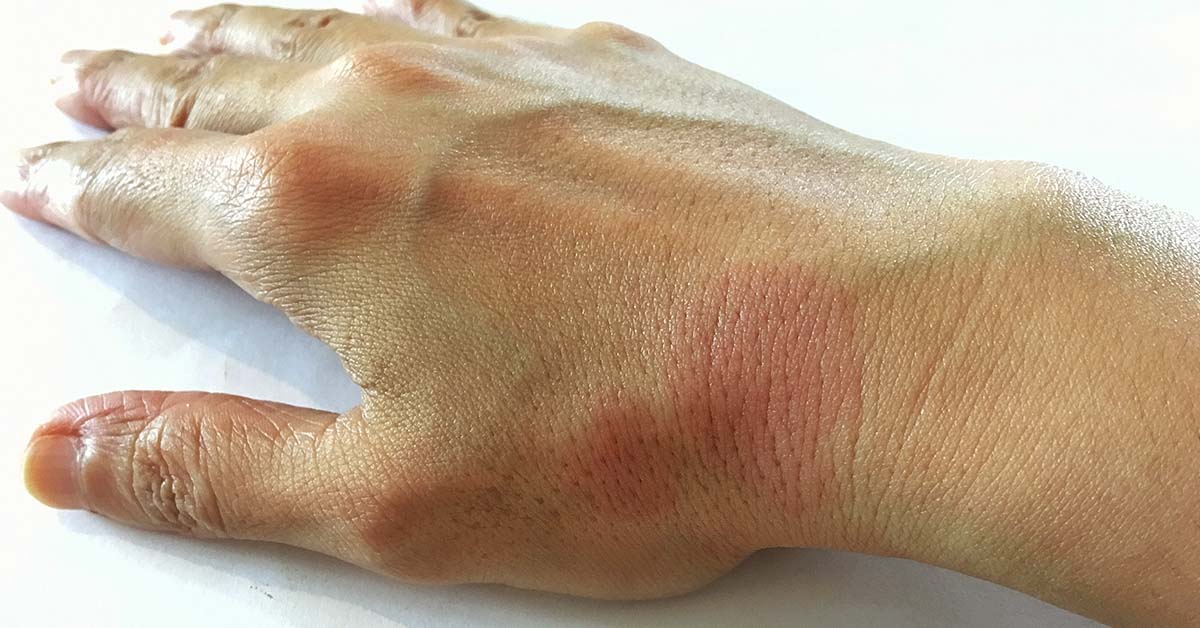 Hand with rash. Lupus symptom concept