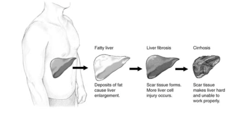 Medical diagram showing progression from healthy liver to fatty liver, fibrosis, and cirrhosis stages of alcohol-related liver damage.