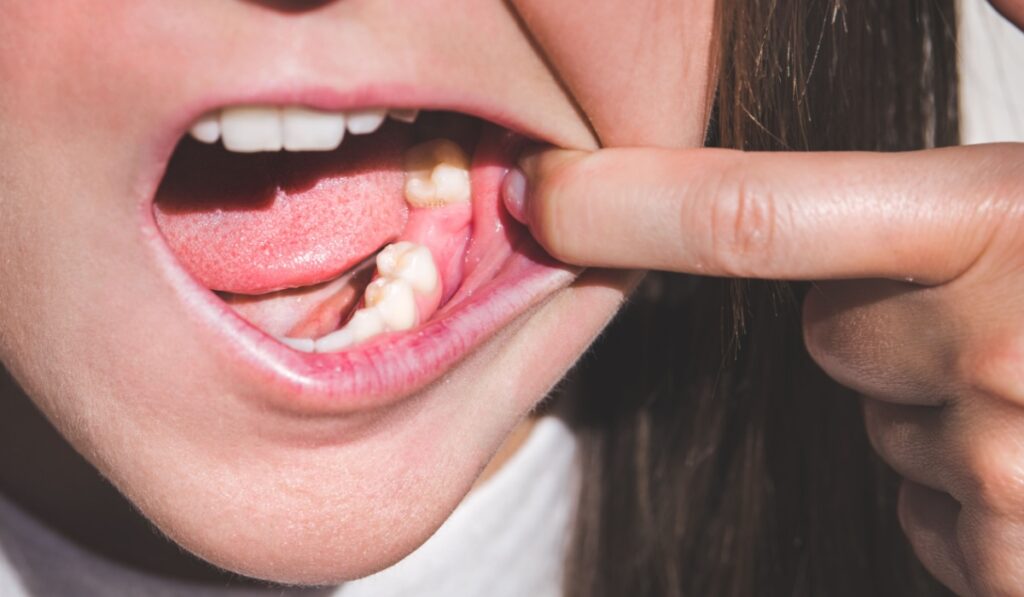 Young woman showing mouth without tooth on lower jaw. Missing tooth. Waiting an implant after tooth extraction