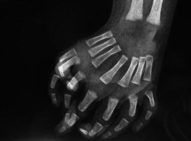 A radiography showing seven triphalangeal digits with seven corresponding metacarpals all in one plane.