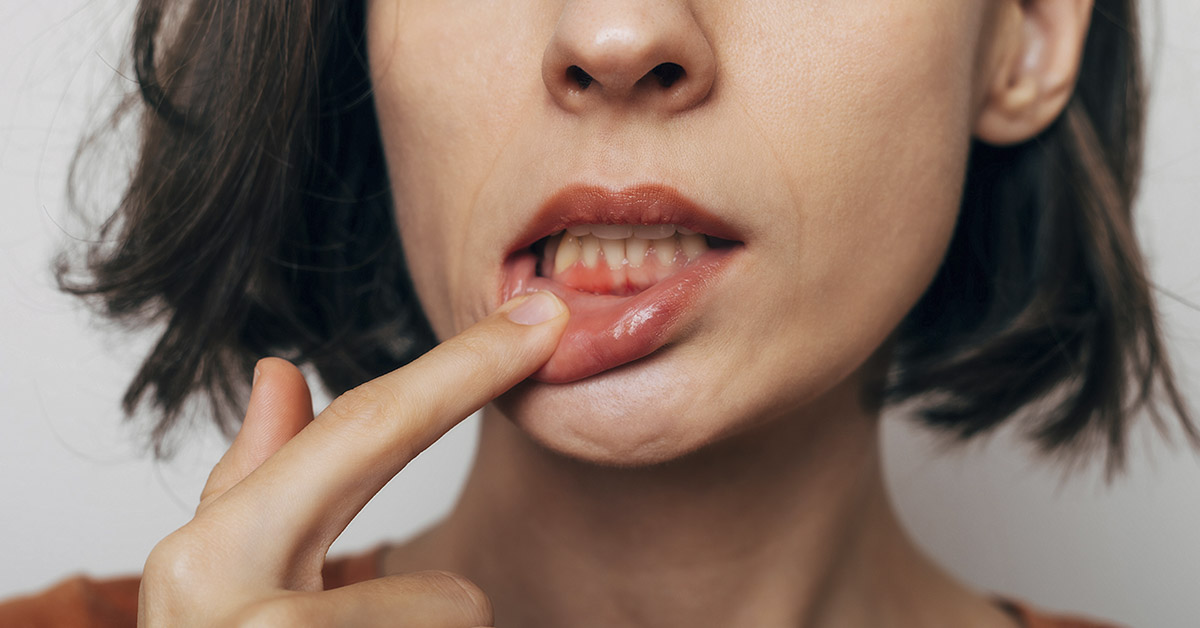 woman pressing down lower lip to expose teeth. Dental, gum, and oral health concept. Gum disease concept.