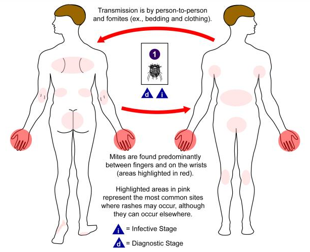 Drawing that shows how scabies passes from person to person. The red and pink areas on the body outlines show where rashes often appear. The picture also shows that scabies spreads through skin contact and by sharing things like clothes and bedding.