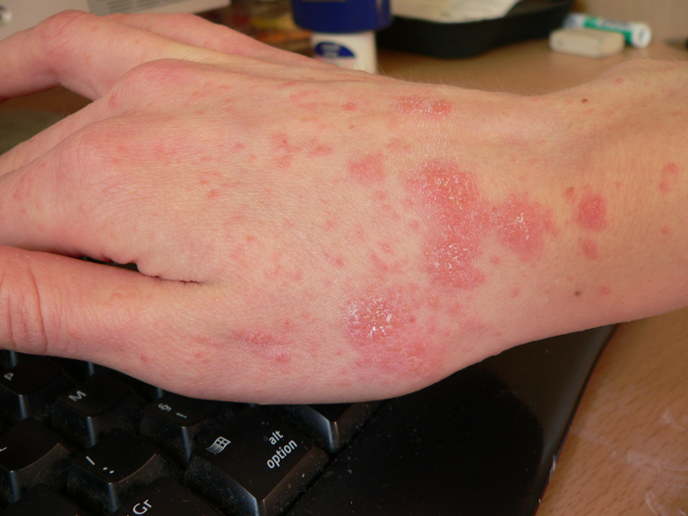 Hand with many red spots on skin from scabies. The bumps and lines on the wrist and hand show what happens when tiny mites dig under your skin. These spots often itch like crazy, especially at night when you're trying to sleep.