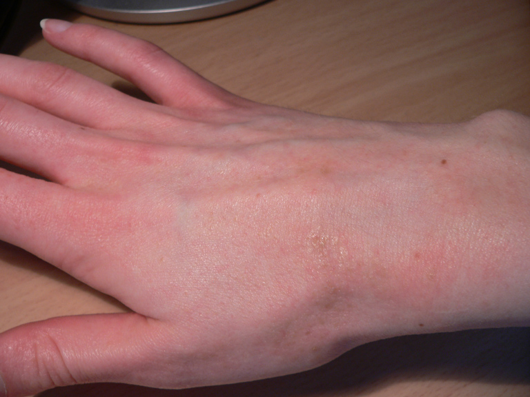 Hand that's almost healed after scabies treatment. The skin looks much better with only a little redness left. This shows what happens when treatment works right. Your skin can return to normal, though some itching might last a few more weeks.