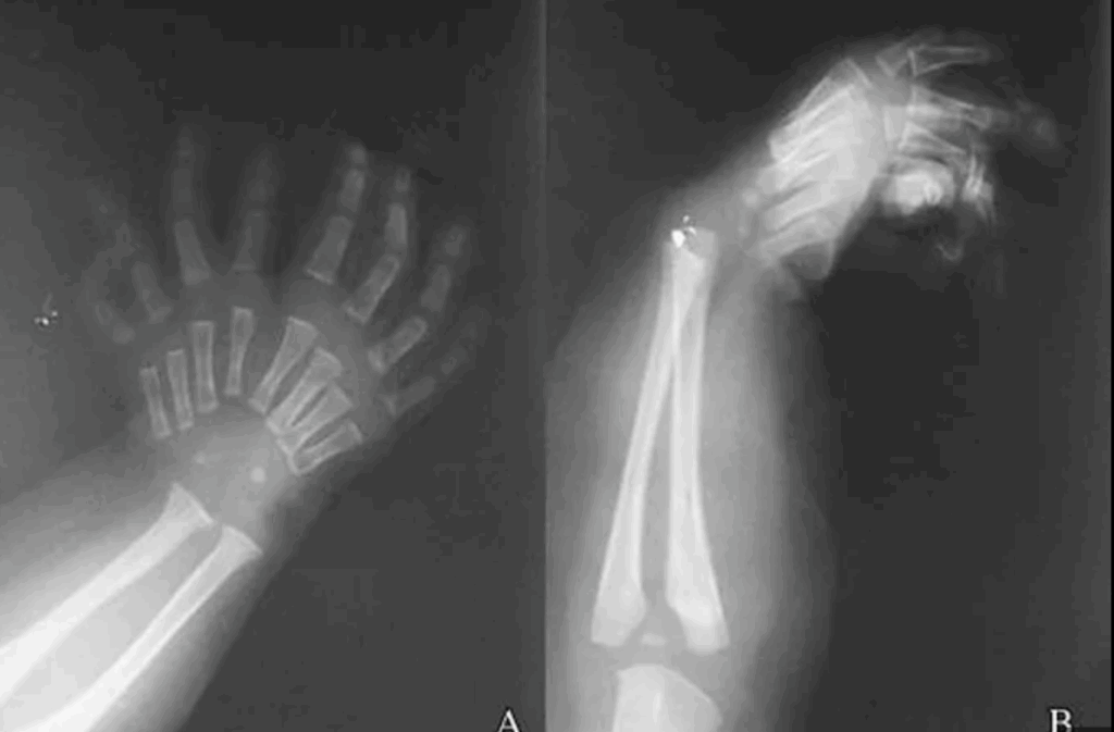 Mirror hand syndrome