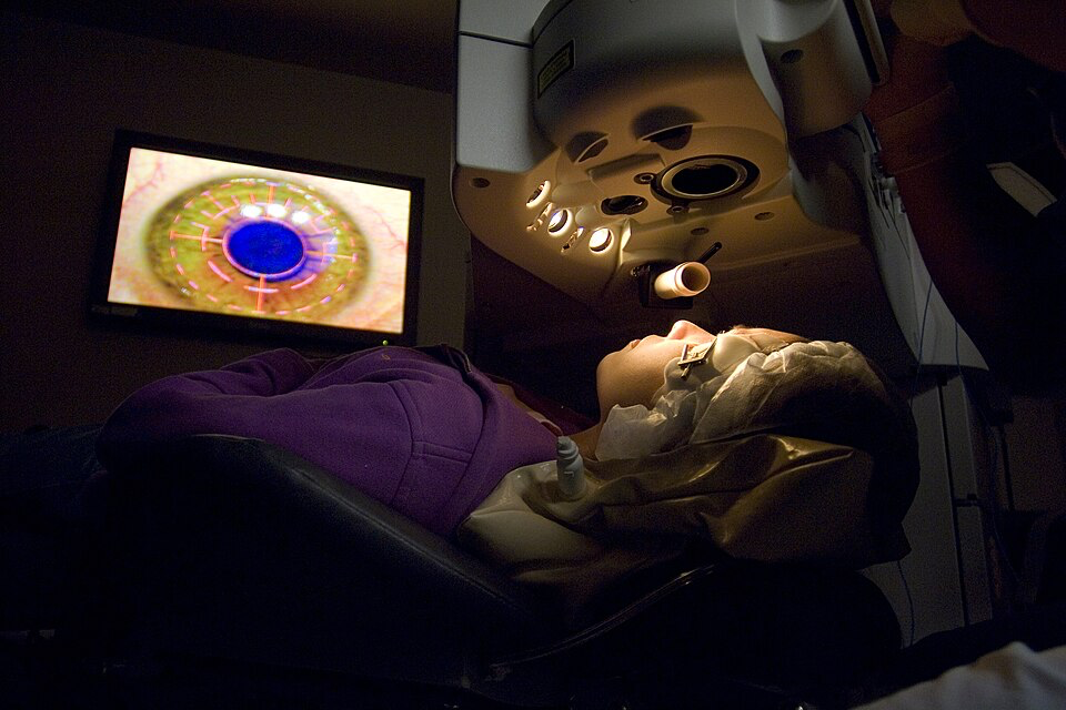 A patient lying on a surgical table during eye surgery, with a large machine above them and a screen showing an eye image, used to show the surgical procedure that 800,000 Americans get each year.