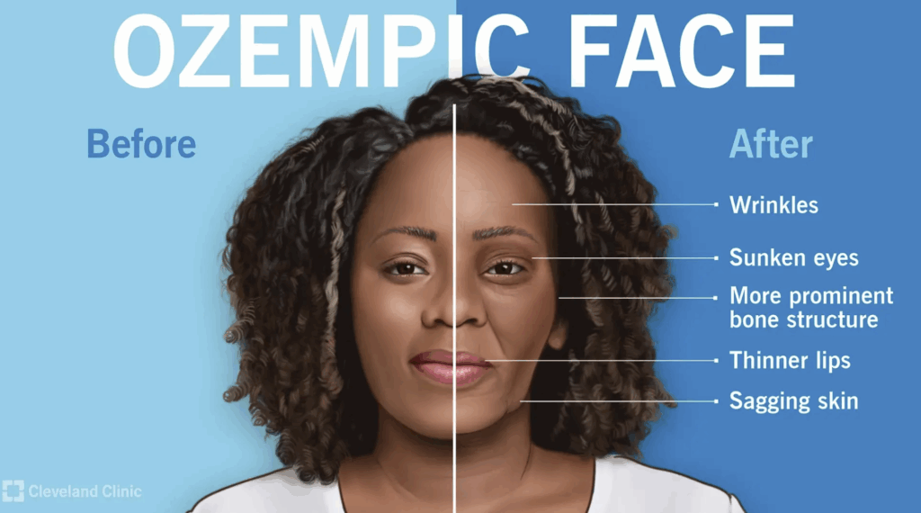 ozempic face