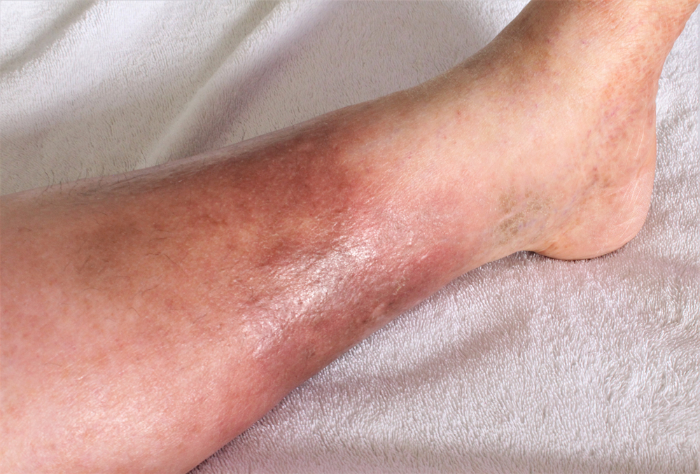 A woman's leg is shown, she is suffering from Chronic Venous Insufficiency with mild cellulitis in her legs. In bed as she rest to relieve heaviness, swelling, pain redness in the leg. Top shot