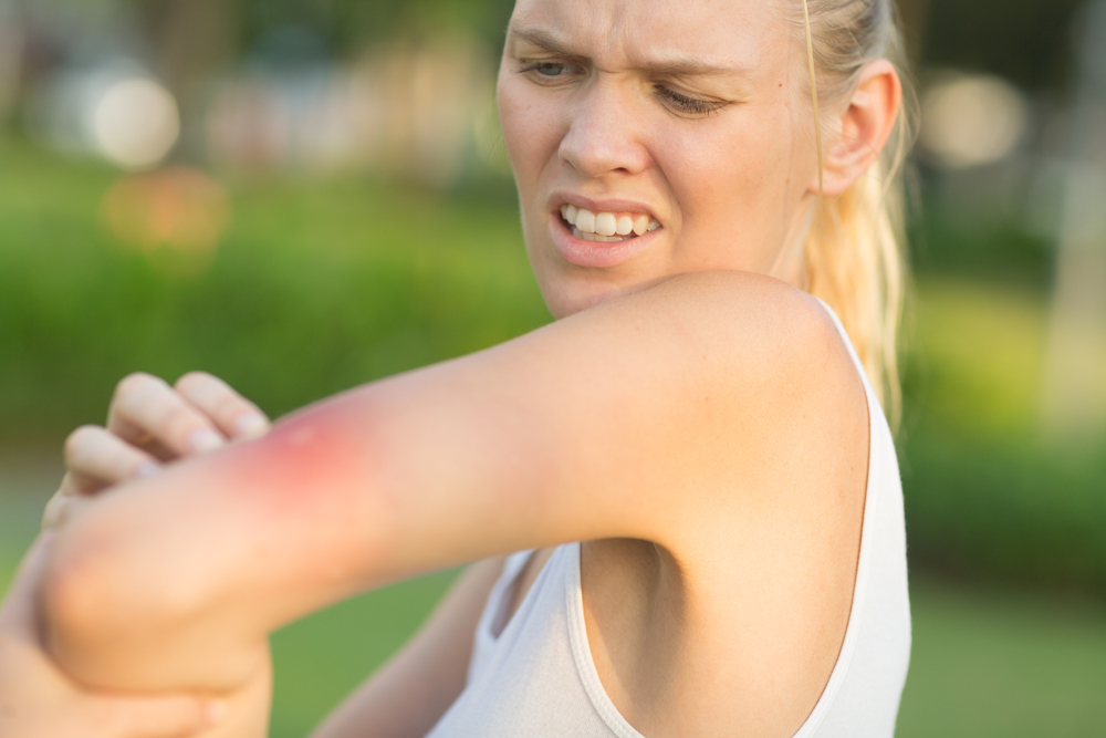 Itchy insect bite - Irritated young female scratching her itching arm from a mosquito bite at the park during summertime.