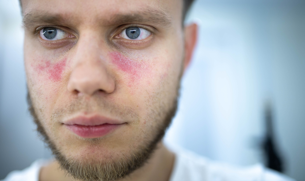 age spots of redness on the face, a young man is sick systemic lupus erythematosus
