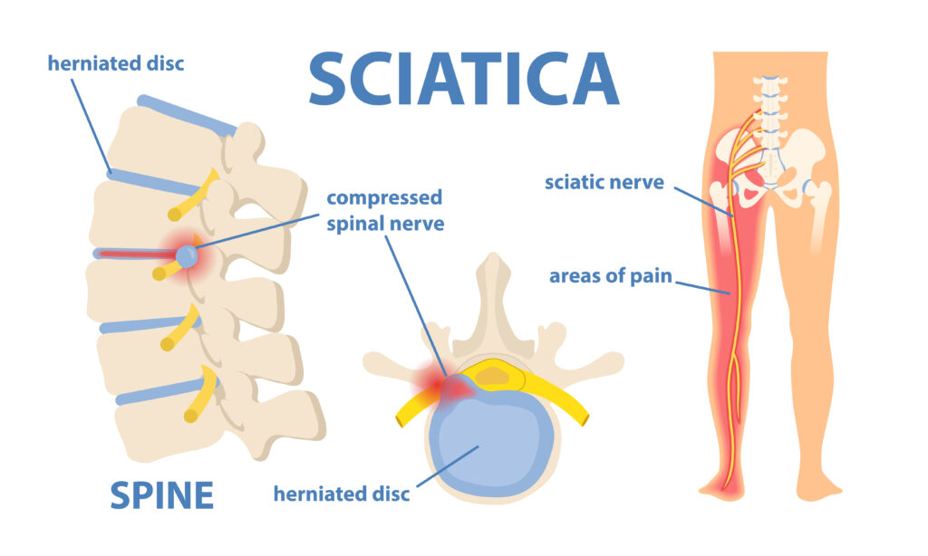 Sciatic nerve pain in the lower back through hip, thigh, knee to leg. Educational or informational poster. Flat vector medical illustration isolated on white background