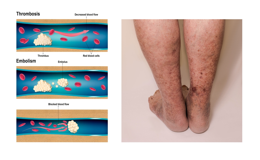 Deep Vein Thrombosis or Blood Clots. Embolus. Structure of normal and varicose male veins. Illustration was created by me