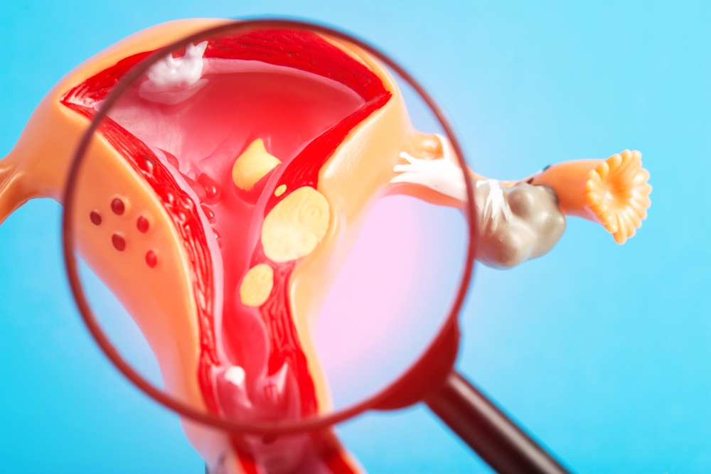 Medical mockup of the female reproductive system under a magnifying glass on a blue background. Concept of inflammation and disease of the cervix. Uterine fibroids and cervical erosion, endometriosis.