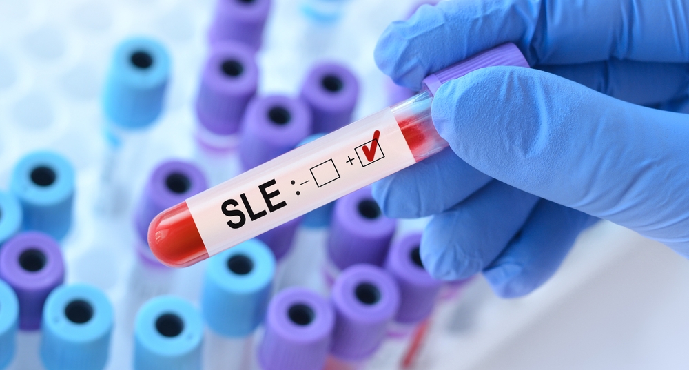 Doctor holding a test blood sample tube with Systemic Lupus Erythematosus (SLE) on the background of medical test tubes with analyzes.
