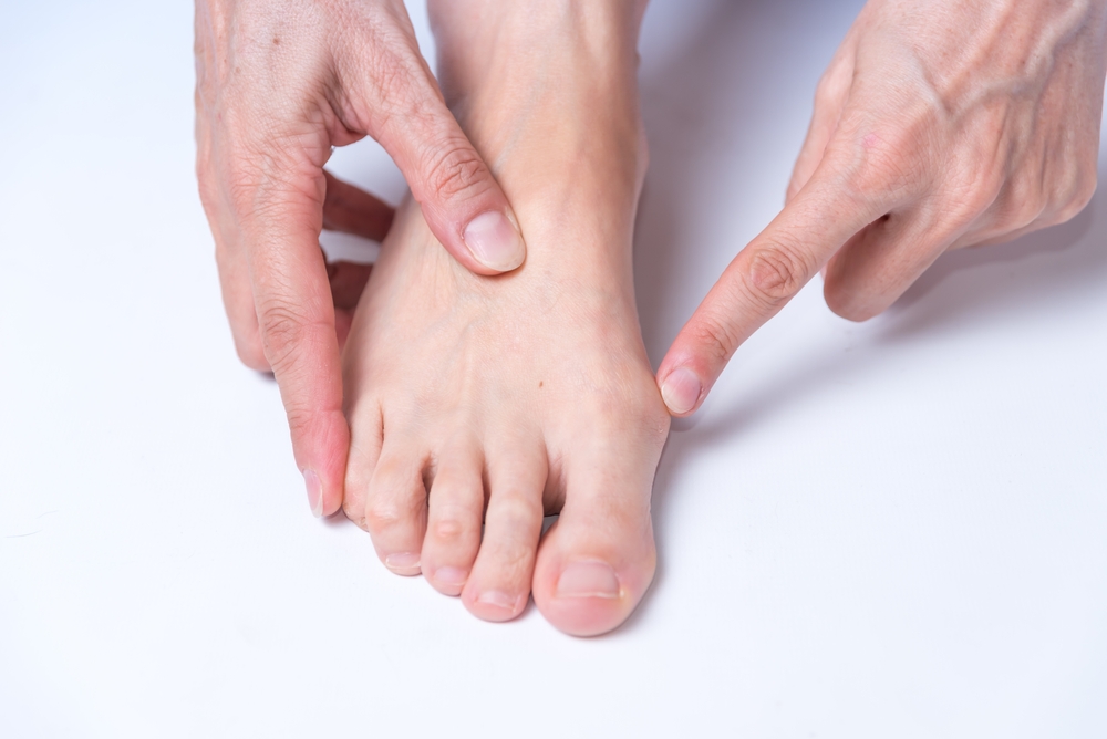  bunion on foot, arthritis, health, body medicine, close up