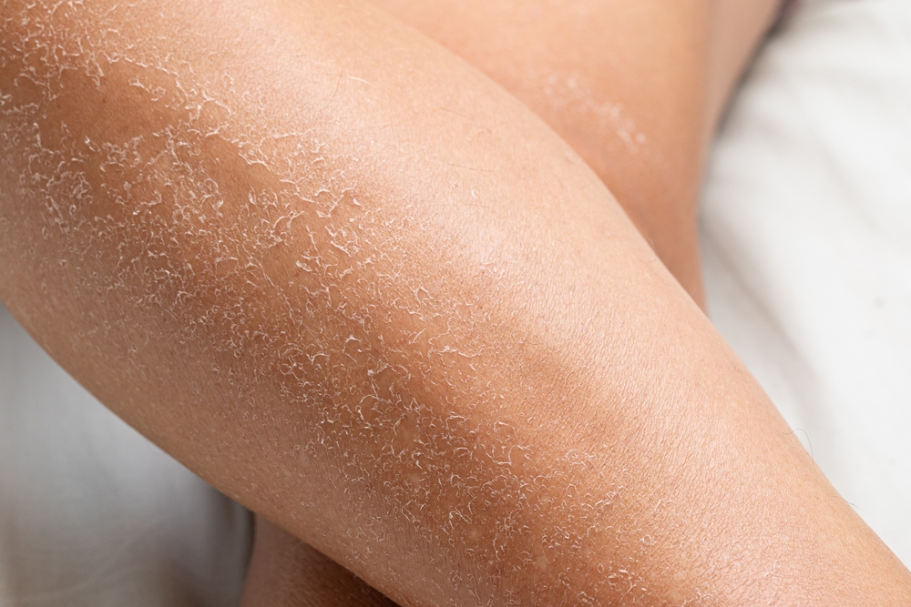 Macro of detail of dry skin of woman legs. Close up of dehydration due to the sun's rays without sun protection cream