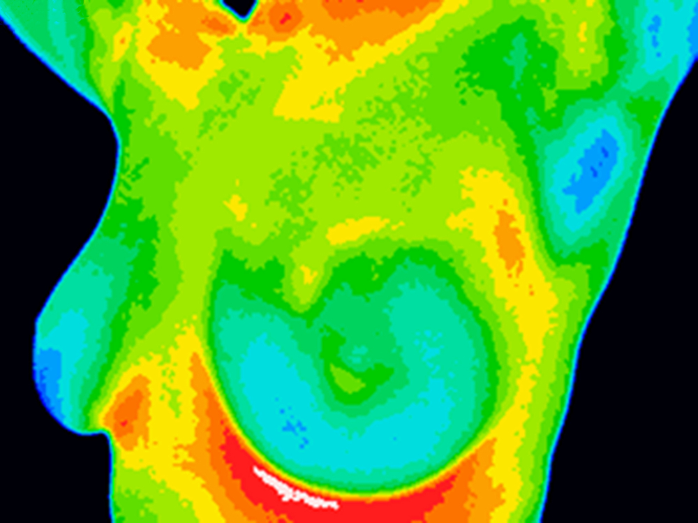 Thermographic image of a chest showing different temperatures from blue showing cold to red showing hot which can indicate inflammation and infection. Image showing healthy breast with no growths.