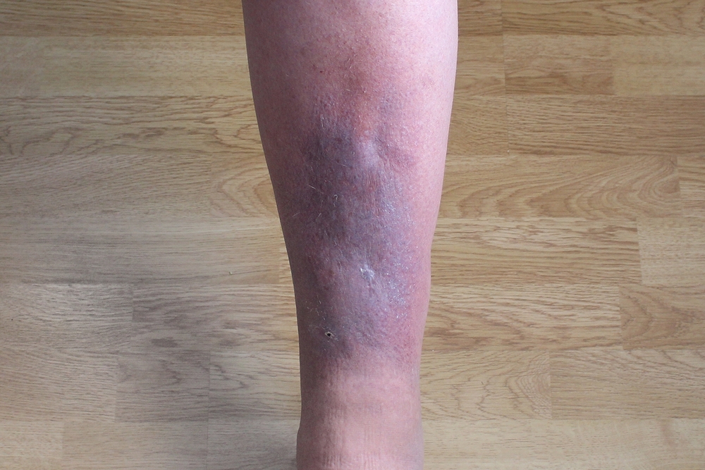 Post-thrombotic disease is a complex of symptoms that develops as a result of venous thrombosis of the veins of the lower limbs.
