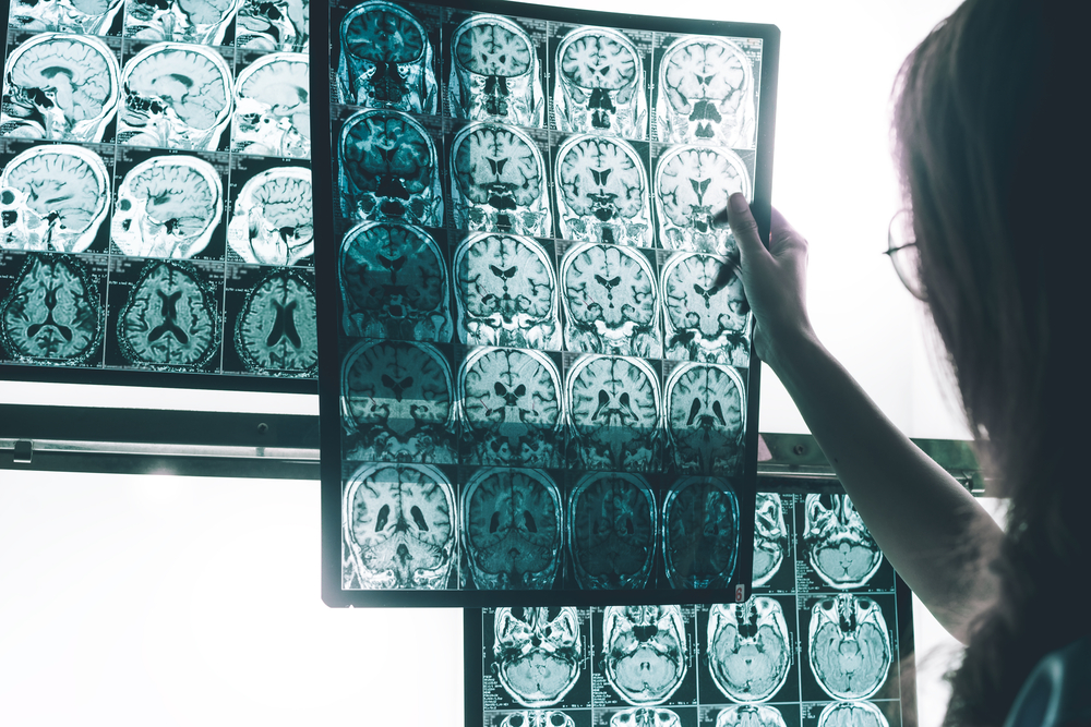alzheimer's disease on MRI